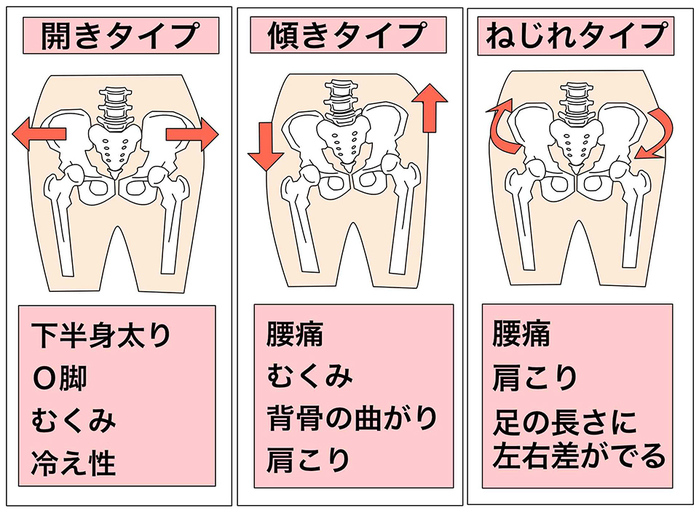 骨盤のゆがみタイプと主な症状