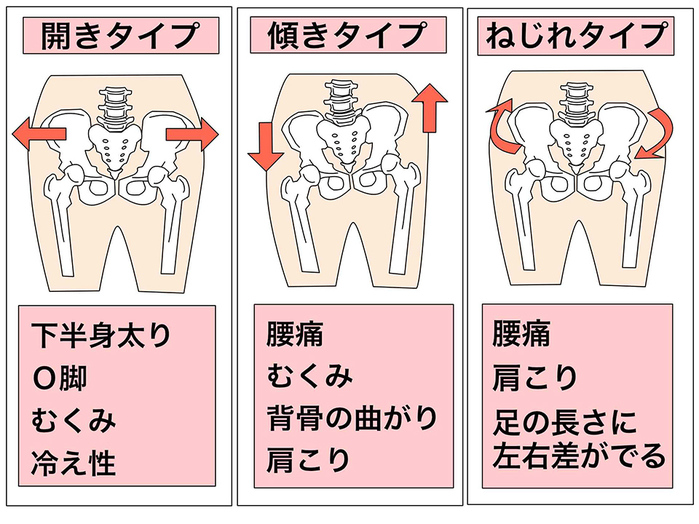 骨盤のゆがみタイプと主な症状