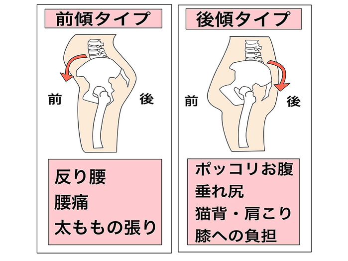 骨盤のゆがみタイプと主な症状